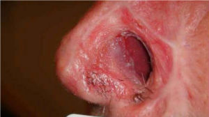 Black Salve warning
